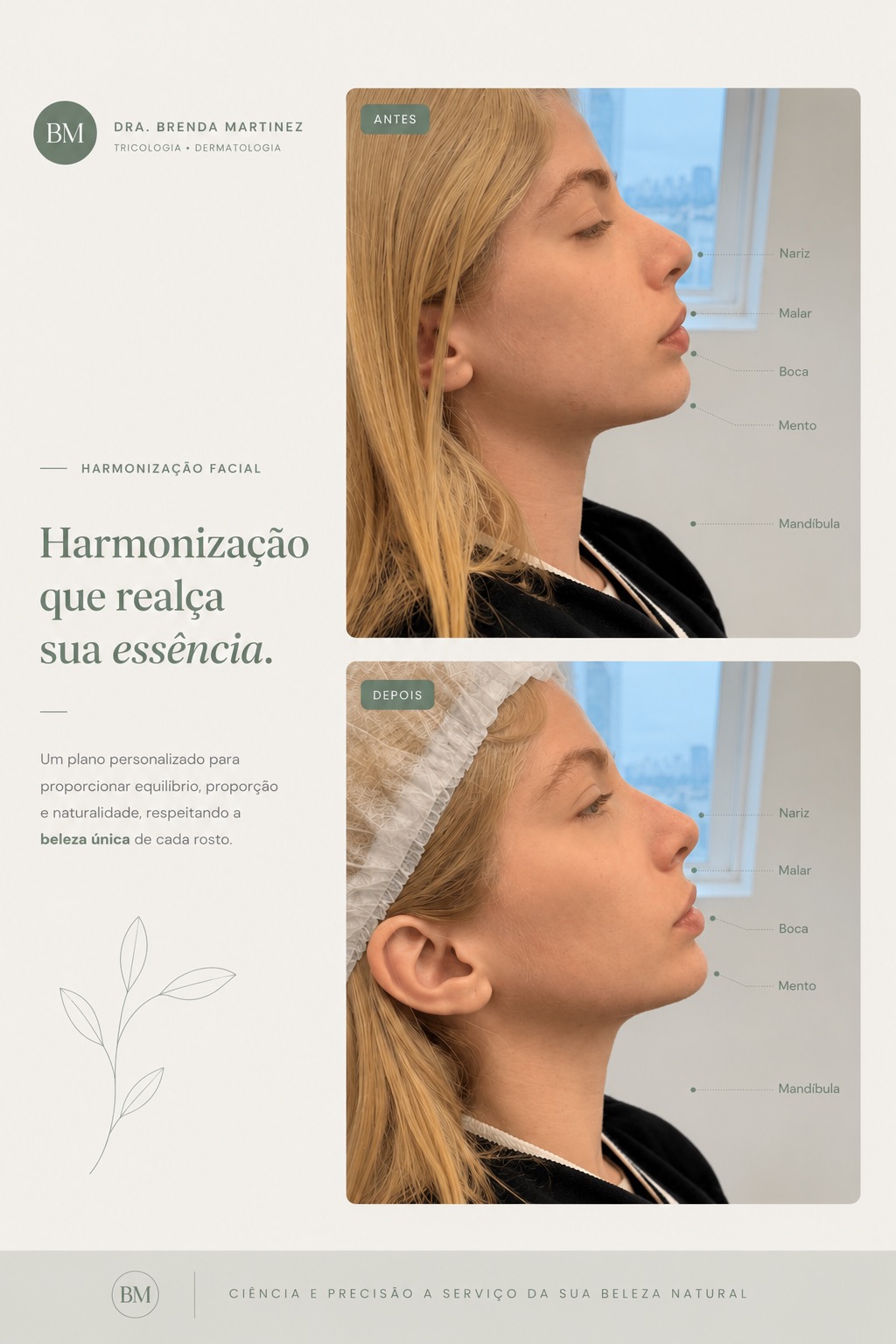 Depois — Harmonização Facial