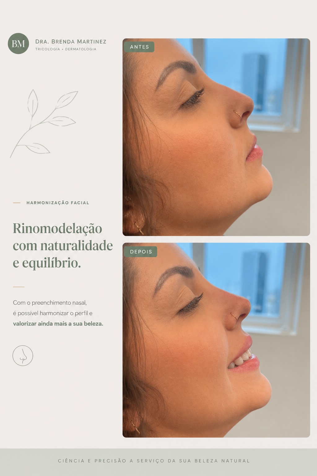 Depois — Preenchimento Nasal